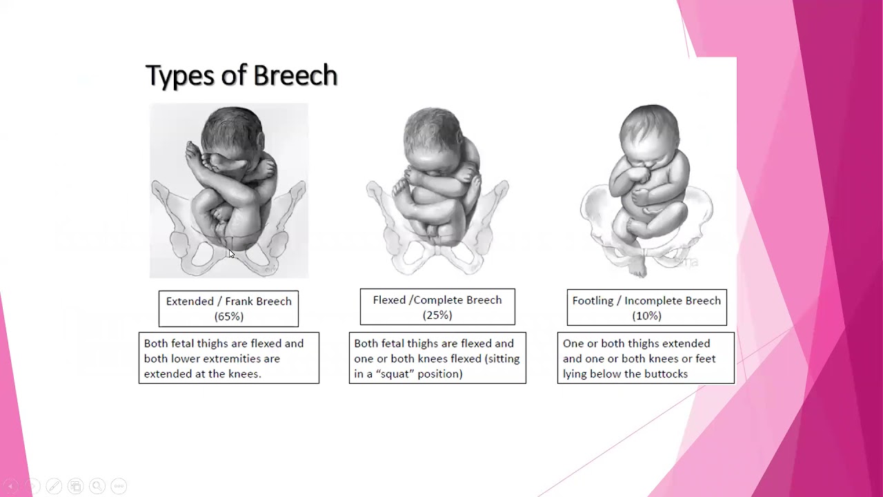 breech presentation lie