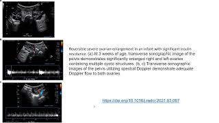 Reversible severe ovarian enlargement in an infant with significant insulin resistance