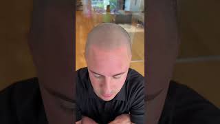 Does scalp micropigmentation work on light or pale skin? #scalpmicropigmentation