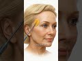 Липофилинг одной зоны? Не лучшая идея! / Протасов Кирилл Андреевич Пластический хирург