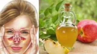 6 Ways To Use Apple Cider Vinegar For Sinus Infection