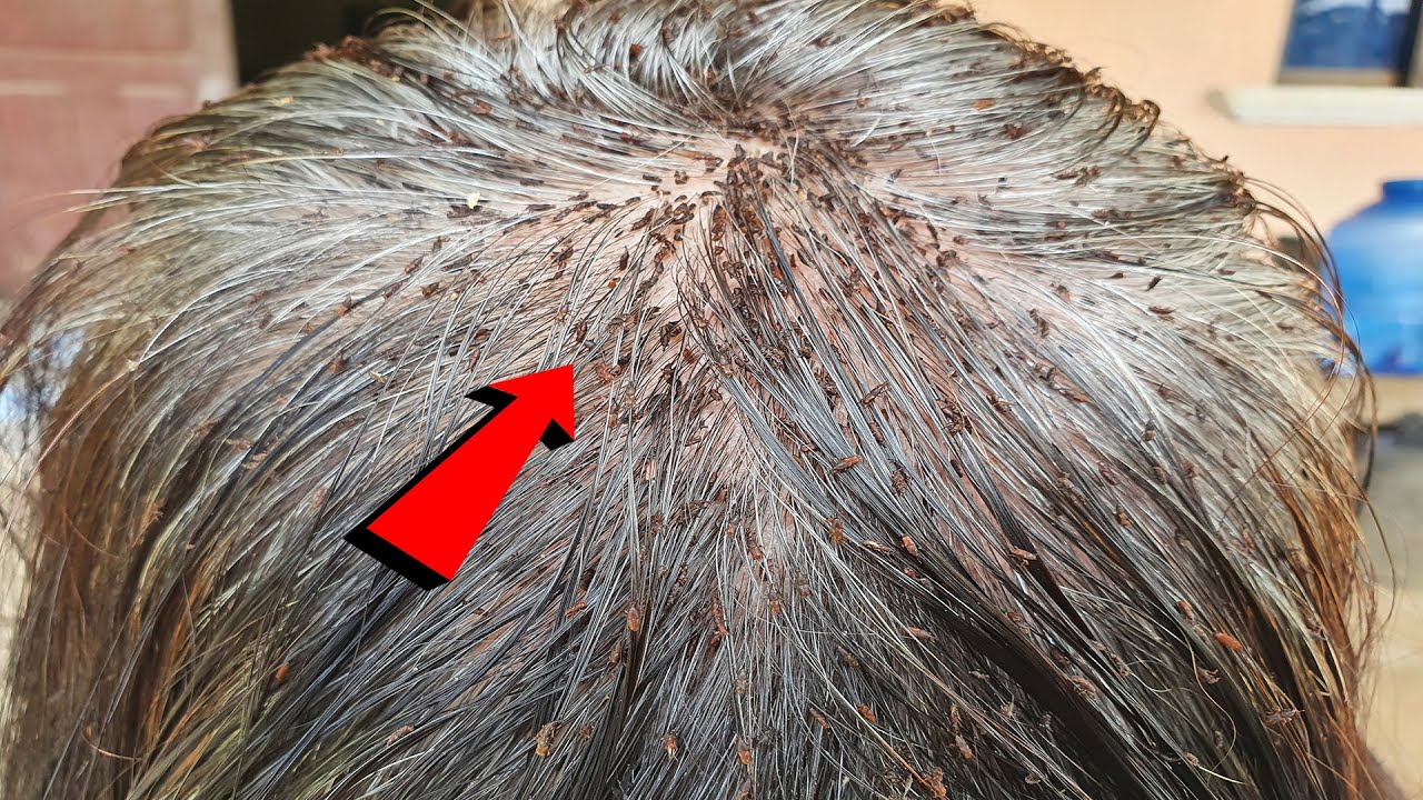 The Ultimate Guide to lice removal Mum Head lice combing YouTube