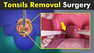 How Tonsillectomy is Performed? | Tonsils Removal Surgery