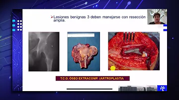 ¿Qué es un sarcoma de cadera?