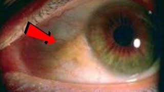 Gözlərdə SARI NÖQTƏ xəstəliyi nədir?