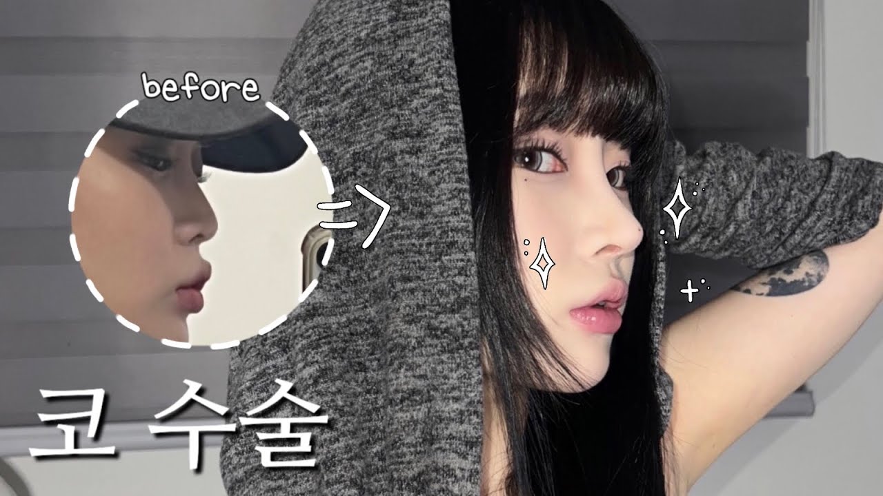 코 수술 vlog👃🏻 | 수술 당일~2달차 회복 과정 • 코 재수술 • 자가늑 후기