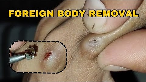Foreign Object Removal From Finger | ASMR | Foreign Body Removal