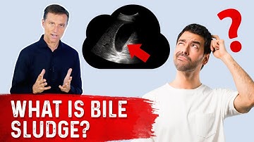 Bile Sludge is a Pre-Gallstone Condition!! – Bile Sludge Treatment Covered by Dr. Berg