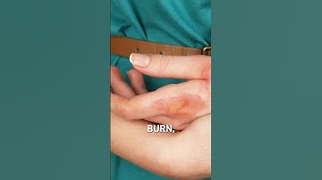 How to Treat a Skin Burn ? | Skin Burn Treatment | #shorts