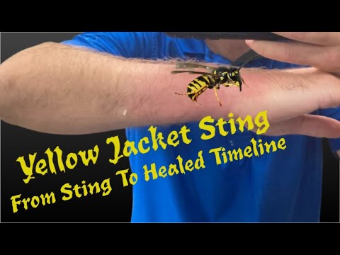 Видео: Yellow Jacket Sting  - From Initial Sting To Fully Healed