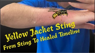 Yellow Jacket Sting  - From Initial Sting To Fully Healed