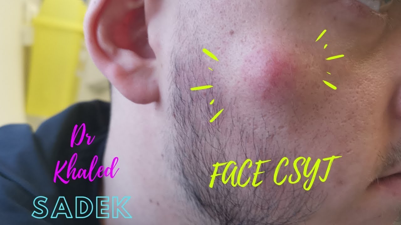 Infinite Sebaceous Cyst Excision