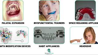 Functional, Expansion and Growth Modification Appliances https://www.straightsmilesolutions.com/ Expansion And Arch Development Appliances Https Www Straightsmilesolutions Com