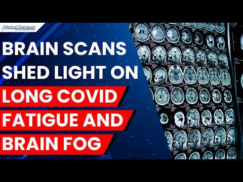 Scientists Find Brain Scan Clues Behind Long COVID Fatigue and Brain Fog