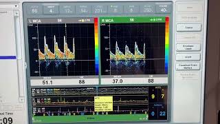 Transcranial Doppler Microemboli monitoring