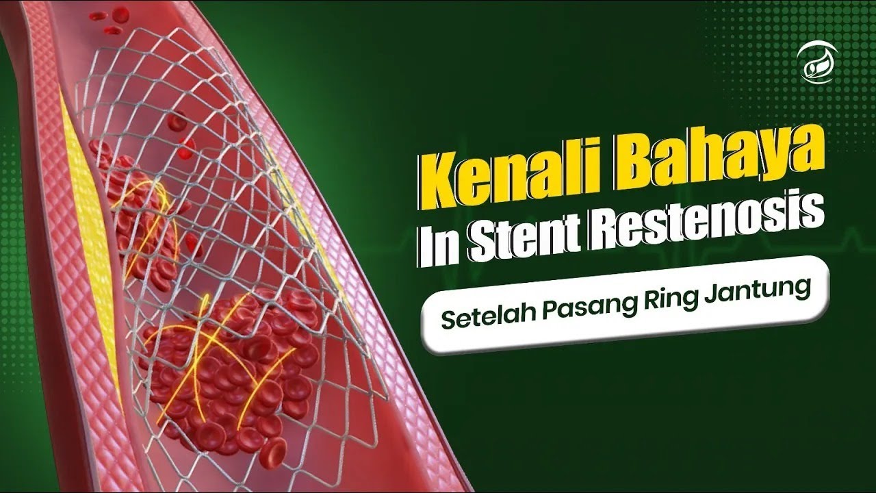 Awas Rind Sudah Pasang Ring Jantung? Awas! Bahaya Instent Restenosis Mengintai ...
