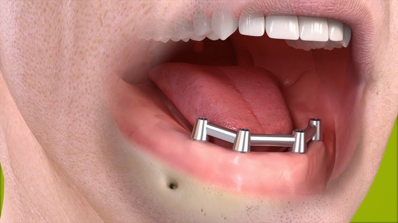 Complete Tooth Replacement With A Removable Implant Bar Supported