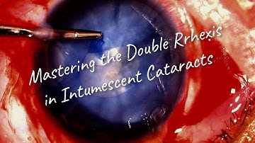 How to Master the Double Rhexis Technique for intumescent cataract - a video guide