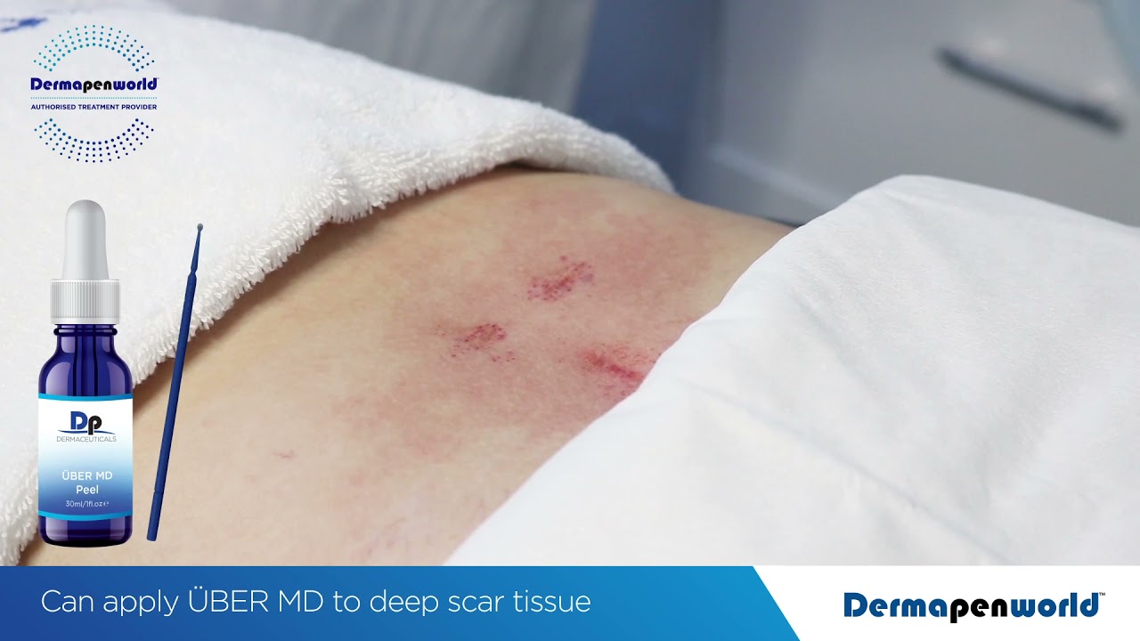 Scar Treatment Protocol - Demo by Dr Andrew Christie
