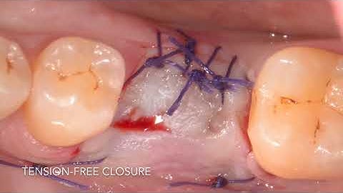 EthOss®: Early Implant Placement & Simultaneous Grafting