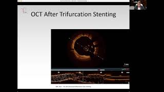 Double TAP in LM trifurcation - Dr Rony MATHEW
