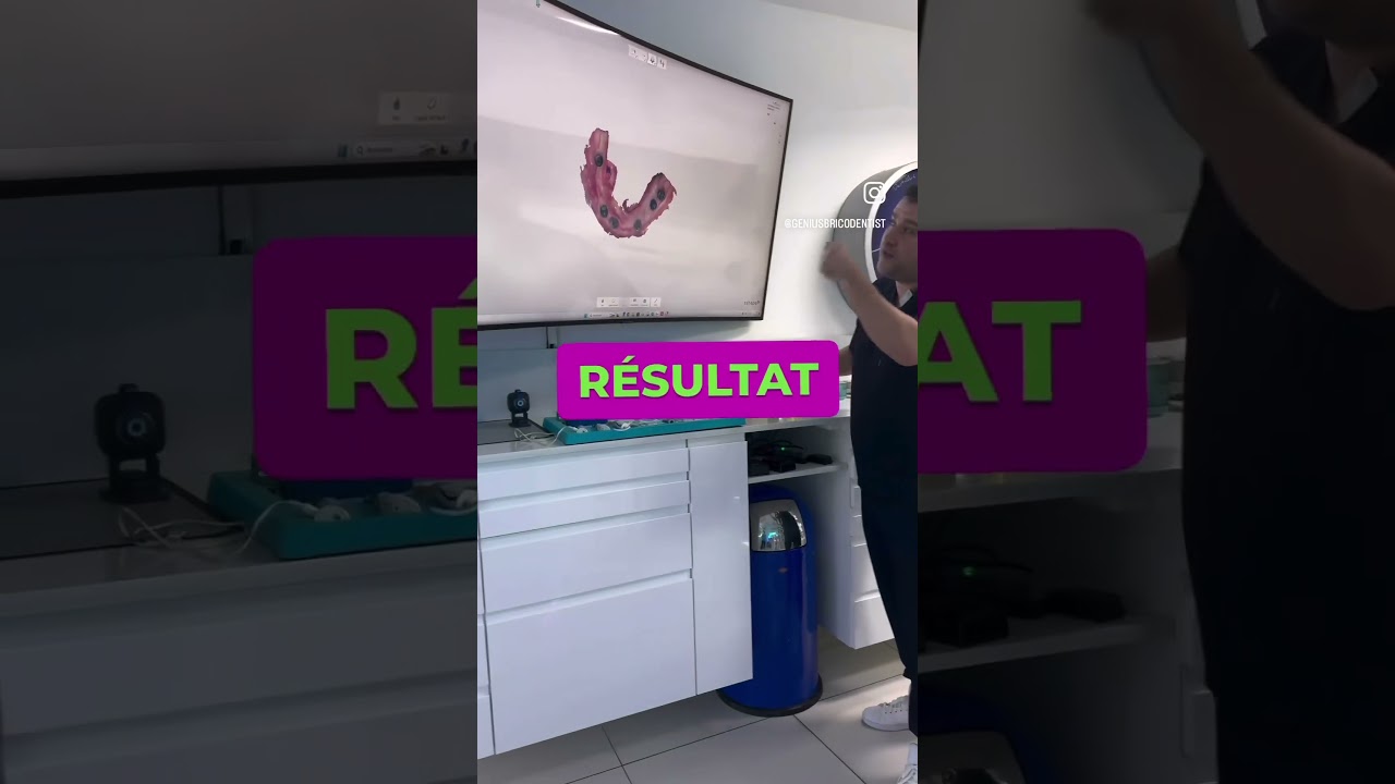 Scanner un bridge sur implant avec la trios 5 de 3Shape 