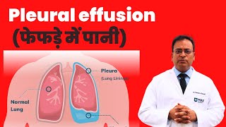 Pleural effusion (फेफड़े में पानी) Pleural Effusion - causes, symptoms, diagnosis, treatment