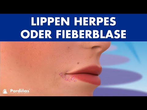 LIPPEN HERPES – Was ist eine Fieberblase und wie wird sie übertragen? ©