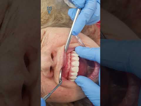 Фиксация верхней челюсти на All on 4. Имплантация зубов.
