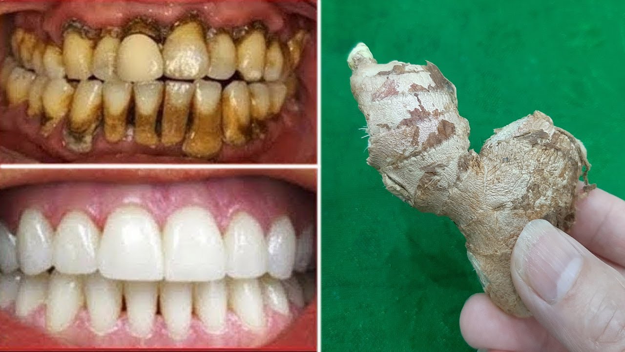 Remove All Tartar and Yellow Stains On Teeth At Home Without Going To