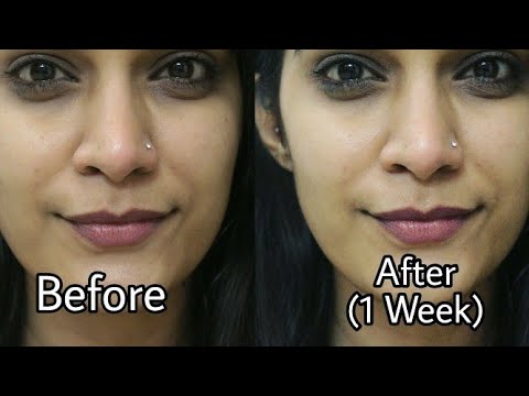 How to Remove Pimple & Acne Scars | Home Remedies For Pimple Removal | Super Style Tips