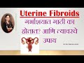 Uterine fibroids        