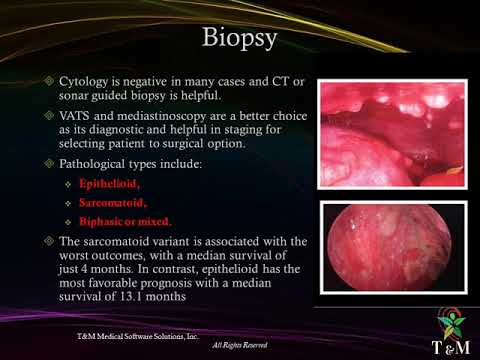 ቪዲዮ: Mesothelioma ወደ አንጎል ሊሰራጭ ይችላል?