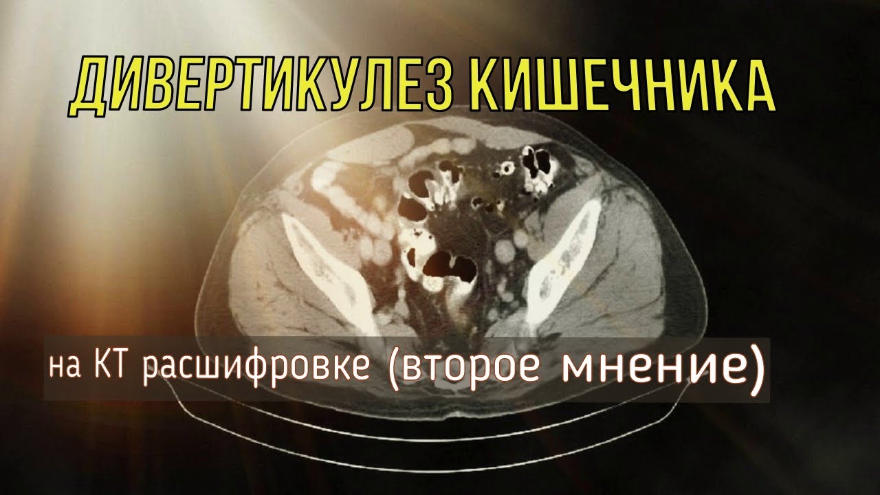 ДИВЕРТИКУЛЕЗ толстой кишки и МЕТАЛЛОКОНСТРУКЦИЯ позвоночника на РАСШИФРОВКЕ КТ брюшной полости