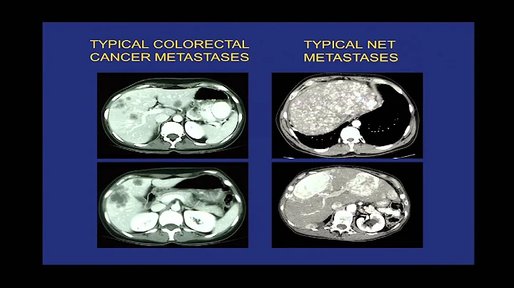 CFCF LA Conference - Pamela Kunz: NETs: Who Gets Them, How to Make the Diagnosis, and How to Treat