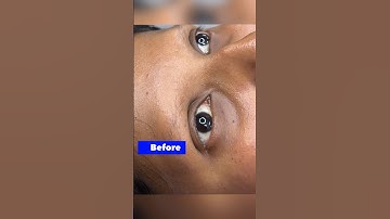 Alopecia patient giving confidence #microshading #microbladingeyebrows #microblading #microblade