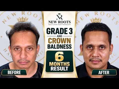 Hair Transplant Results After 6 Months 😍 | 4000 Grafts | Hair Transplant in Raipur | Best Cost