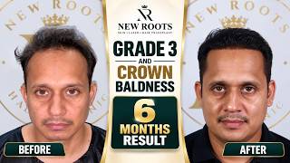 Hair Transplant Results After 6 Months 😍 | 4000 Grafts | Hair Transplant in Raipur | Best Cost
