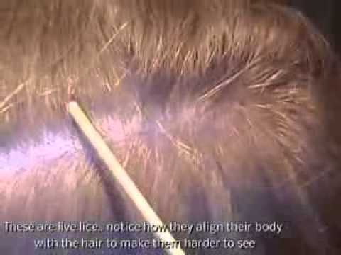 What Do Lice And Nits Look Like In The Hair Youtube