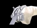 Advance Medial Pivot TKR Animation