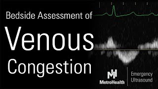 Bedside Assessment of Venous Congestion