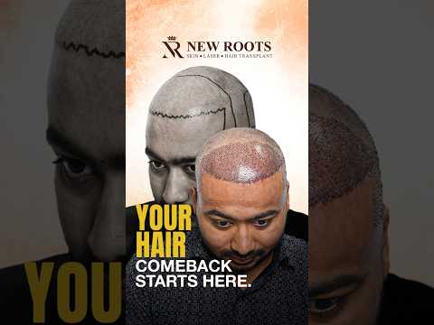 Hair Transplant in Kolkata - 3500 Grafts | Hair Transplant Cost and Best Results #hair #shorts