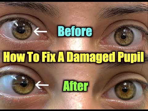 How to fix a damaged pupil. Iris repair to fix a damaged pupil - Pupilloplasty.