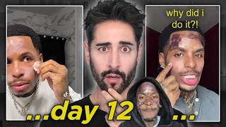 The TIKTOK DIY 30% Chemical Peel….GONE WRONG 😭