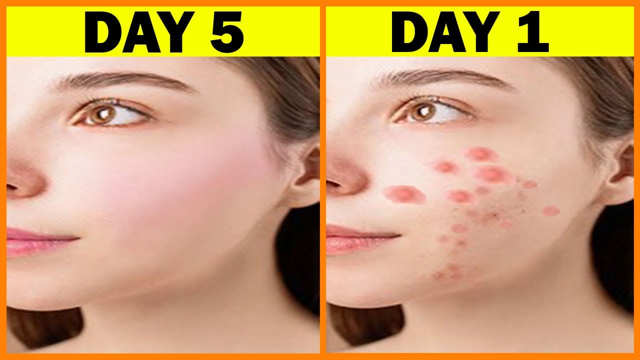 Get Beautiful And Clear Skin Just in 3 Days | How To Get Clear And ...