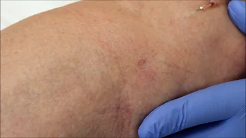 Quanto costa fare il laser per i capillari?