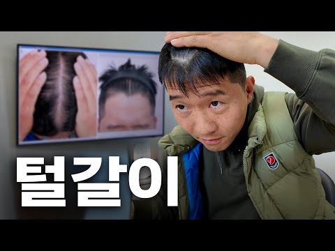 <strong>탈모</strong> <strong>치료</strong> 6개월 차 강형욱 경과보고. [형욱로그]