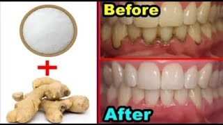 Teeth Whitening At Home In 3 Minutes | | How To Whiten Your Yellow Teeth Naturally |100 % Effective