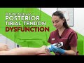 Posterior Tibial Tendon Dysfunction (PTTD) - Chantelle Crossland, Singapore Podiatrist