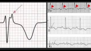 Epsilon wave & its causes. #ECG